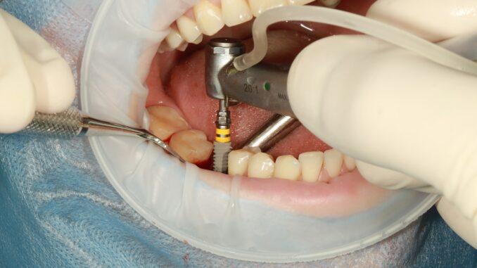 Implant setzen